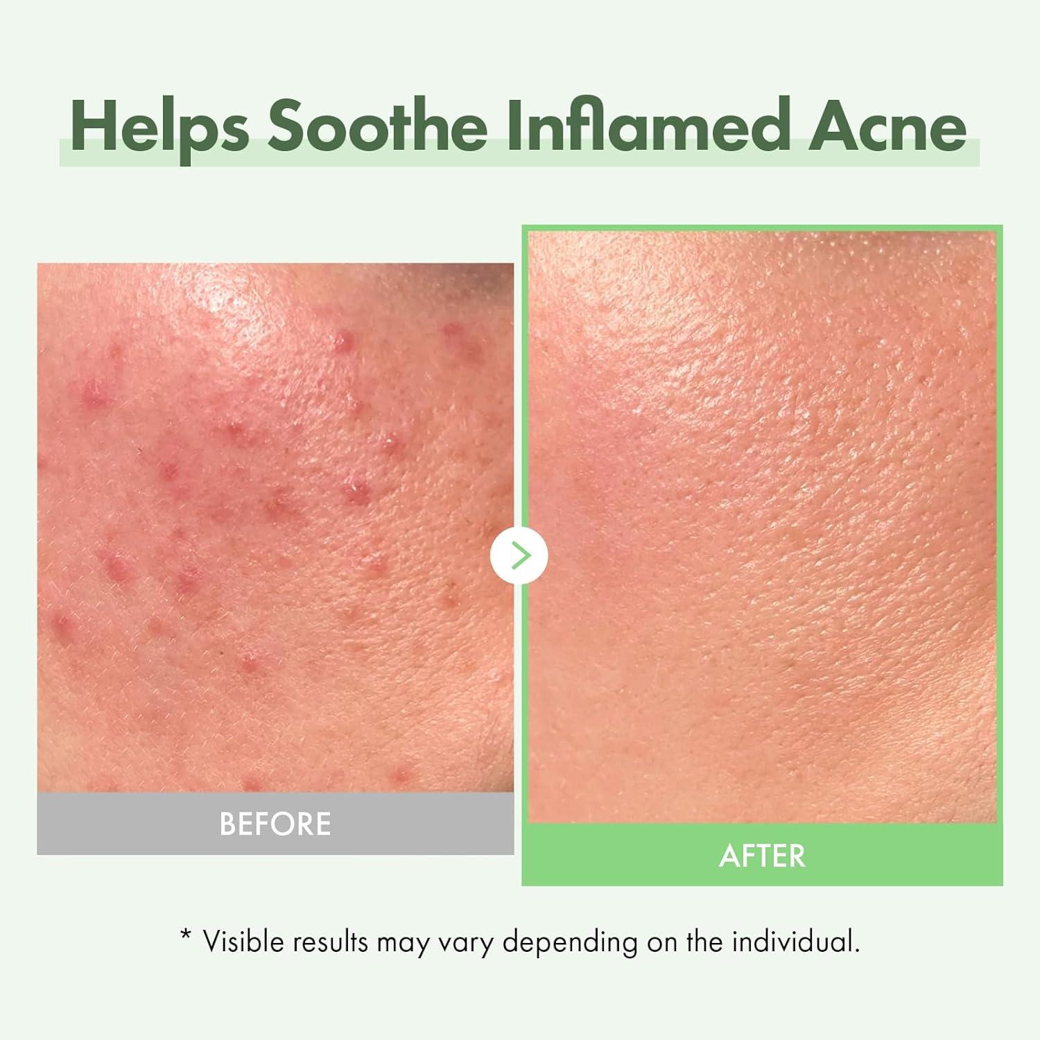 image:imageTOSOWOONG Azelaic Acid 10 Face Serum Rosacea care Redness Soothing and Blemish Centella Asiatica for Acneprone Niacinamide Hyaluronic Acid Korean Skincare Natural Color 33 ml 111 fl oz