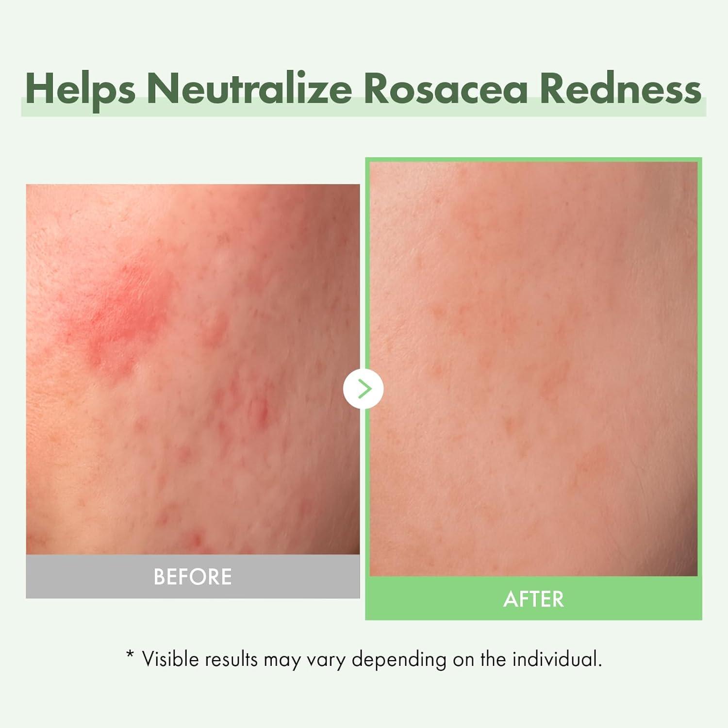 image:imageTOSOWOONG Azelaic Acid 10 Face Serum Rosacea care Redness Soothing and Blemish Centella Asiatica for Acneprone Niacinamide Hyaluronic Acid Korean Skincare Natural Color 33 ml 111 fl oz